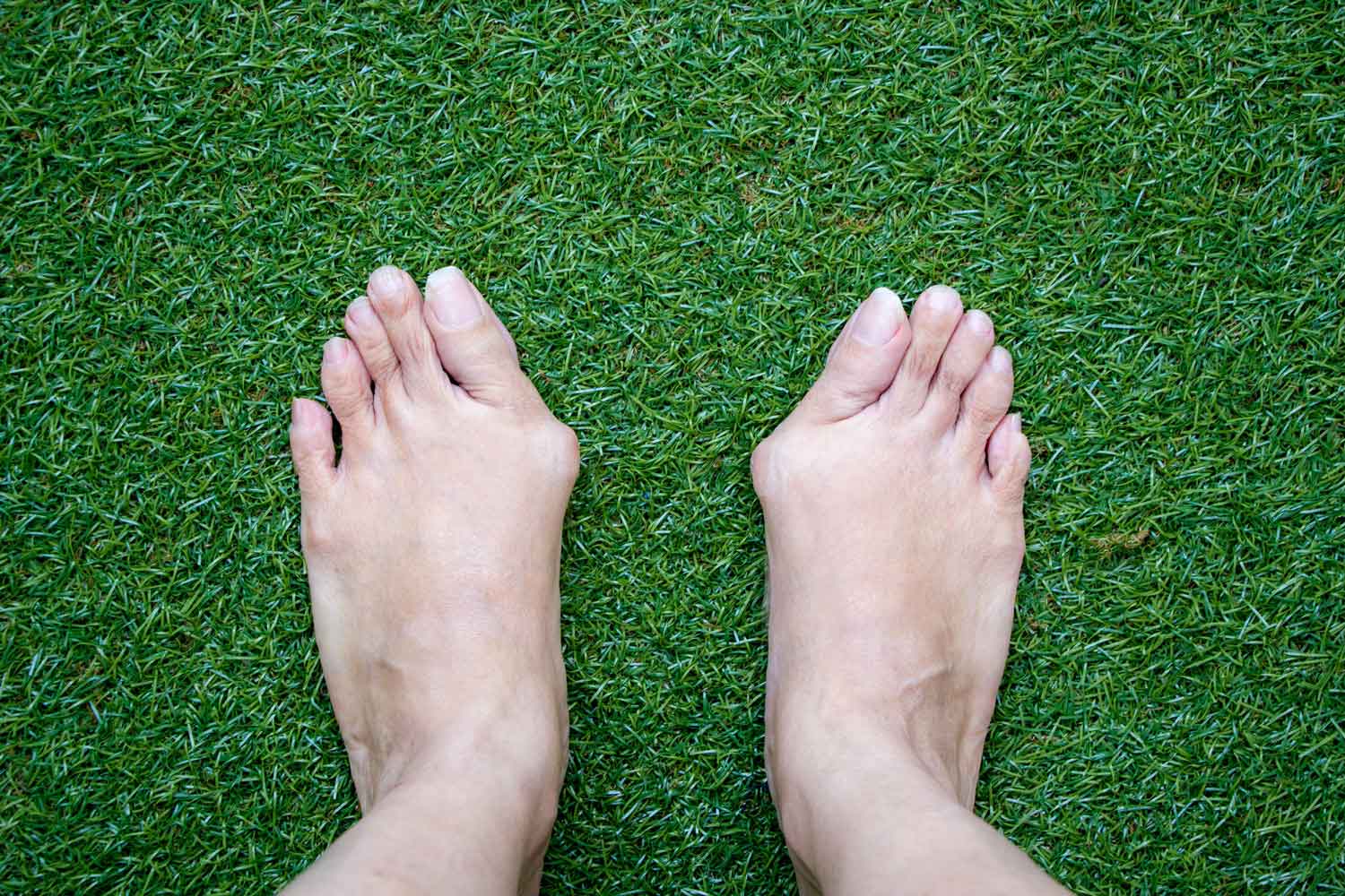 How to Treat and Prevent Bunions: Expert Tips from a Podiatrist